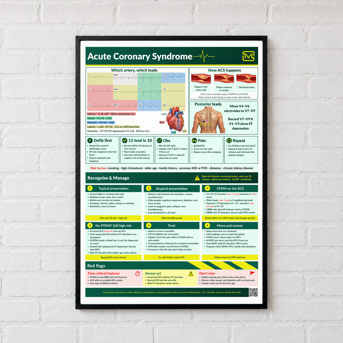 Acute Coronary Syndrome (ACS) ECG Poster