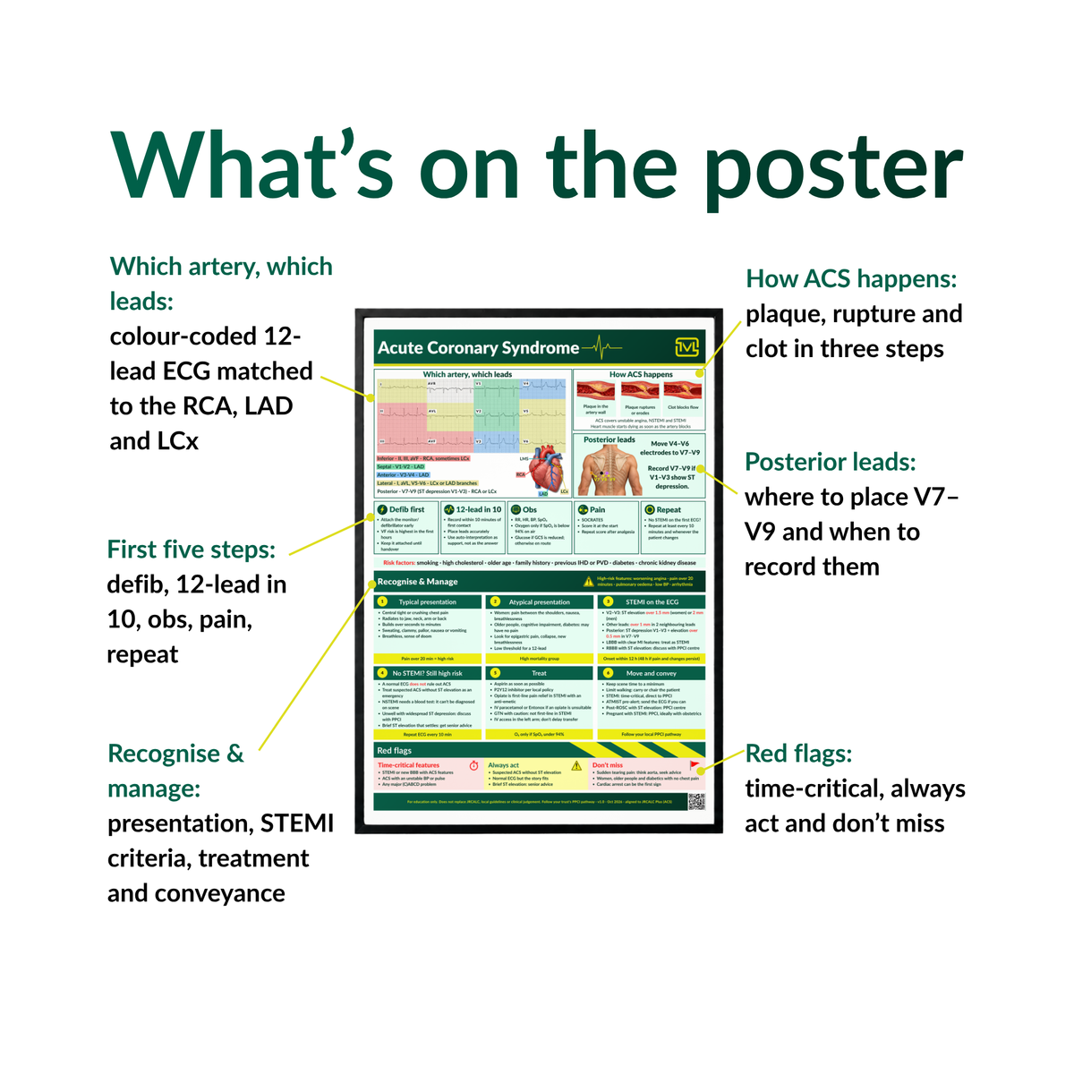 Acute Coronary Syndrome (ACS) ECG Poster