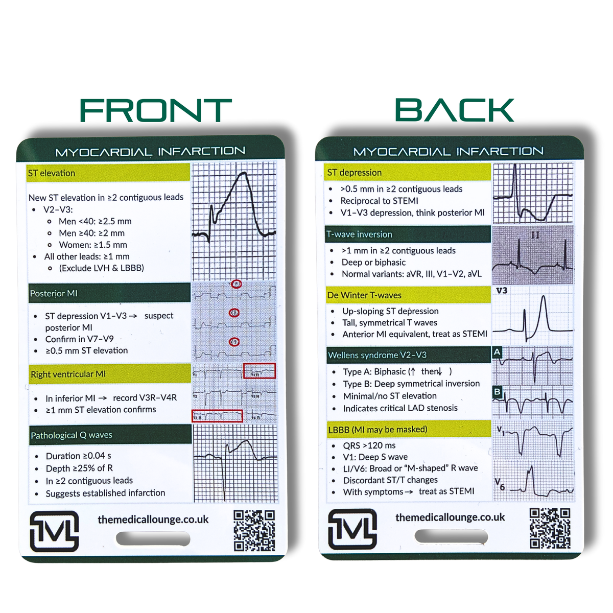 Myocardial Infarction (STEMI) ECG Reference Card
