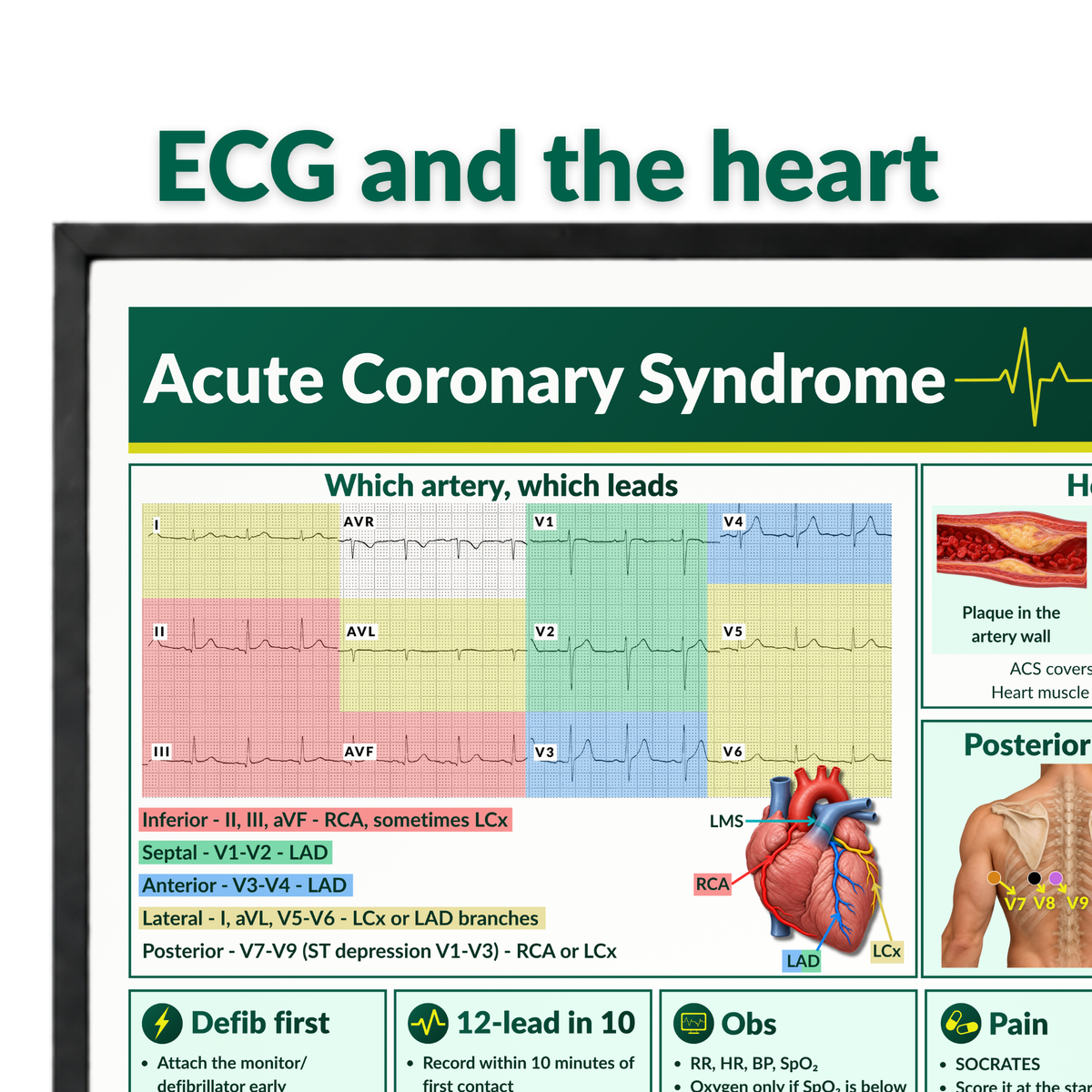 Acute Coronary Syndrome (ACS) ECG Poster